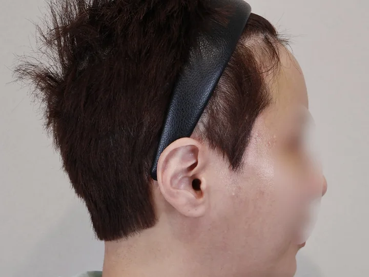 세미거상 상안부 수술 후 6개월 절개 부위