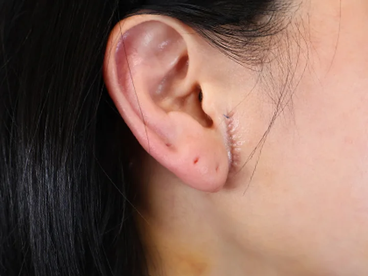 세미거상 하안부 수술 후 7일 절개 부위