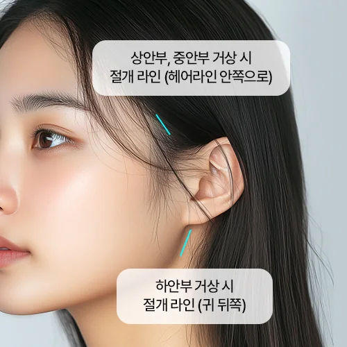 절개 라인 — 상안부·중안부는 헤어라인 안쪽, 하안부는 귀 뒤쪽