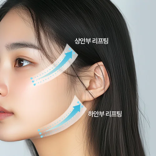 상안부·하안부 리프팅 방향 도해