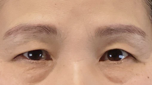 ตัดหนังตาบน · ล่าง — ก่อนผ่าตัด