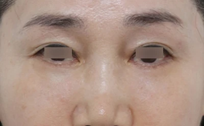 ตัดหนังตาล่างและ Soof Lift — 3 เดือนหลังผ่าตัด