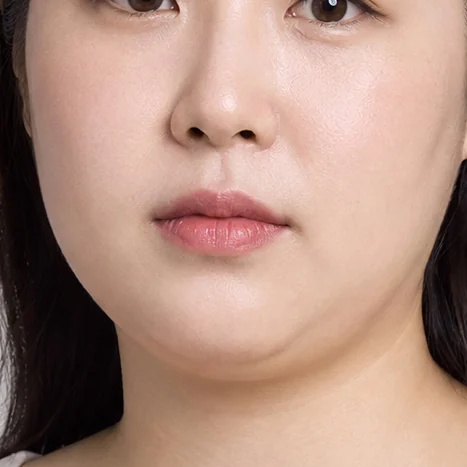 ใบหน้าที่ไขมันลดยากแม้ควบคุมอาหาร