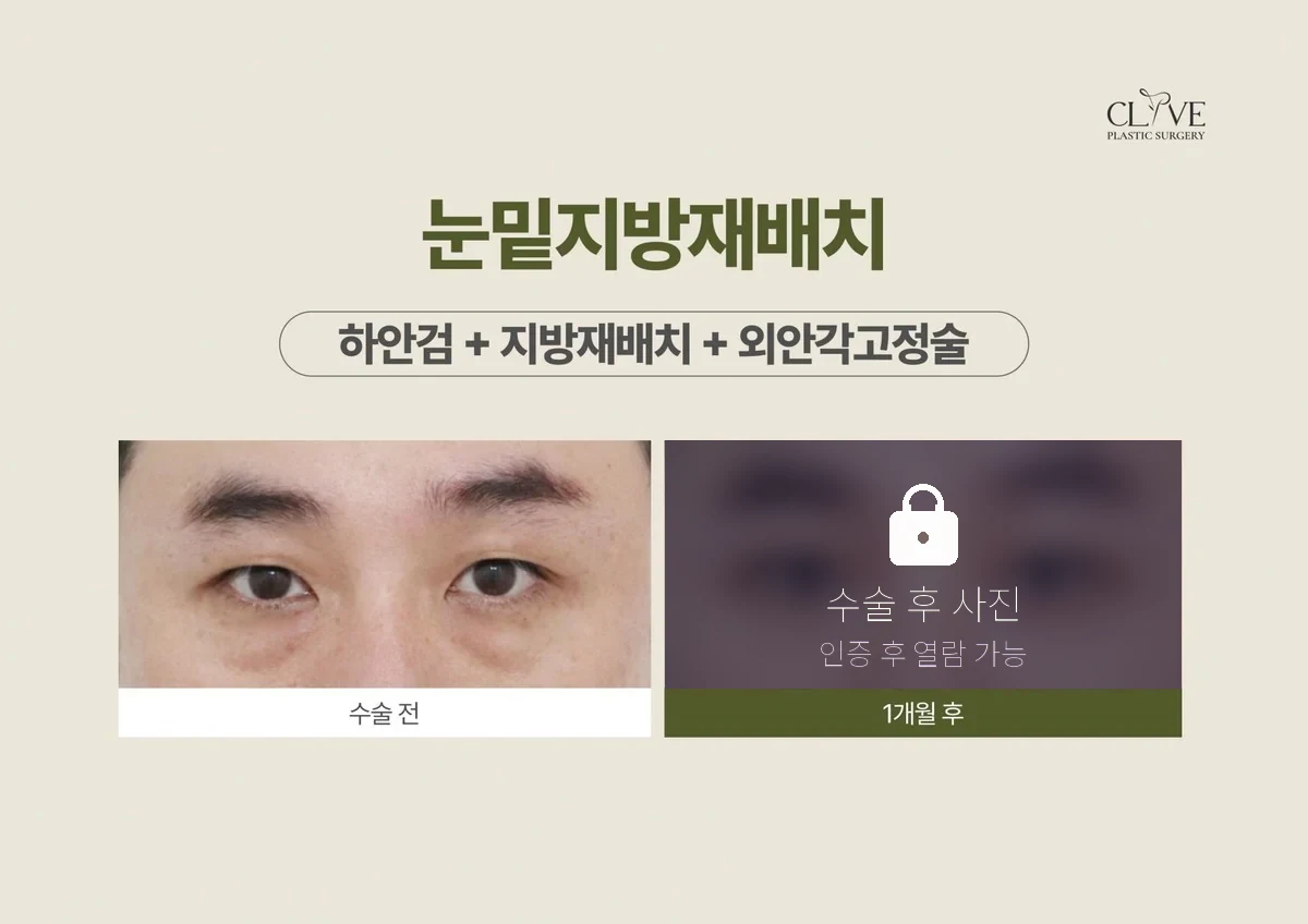 ศัลยกรรมตา — ตัดหนังตาล่าง + จัดเรียงไขมัน + ยึดหางตา ก่อนและหลัง