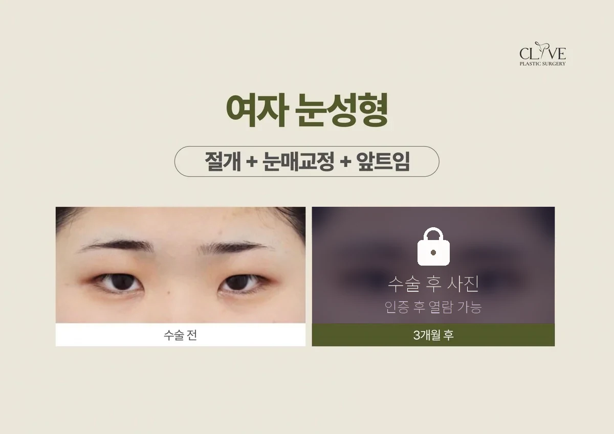 ศัลยกรรมตา — กรีดตาสองชั้น + แก้ไขกล้ามเนื้อตา + เปิดหัวตา ก่อนและหลัง