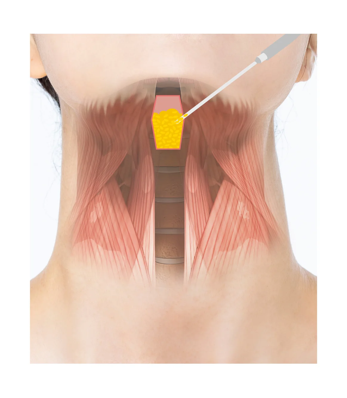 ตัดกล้ามเนื้อ platysma และดูดไขมัน