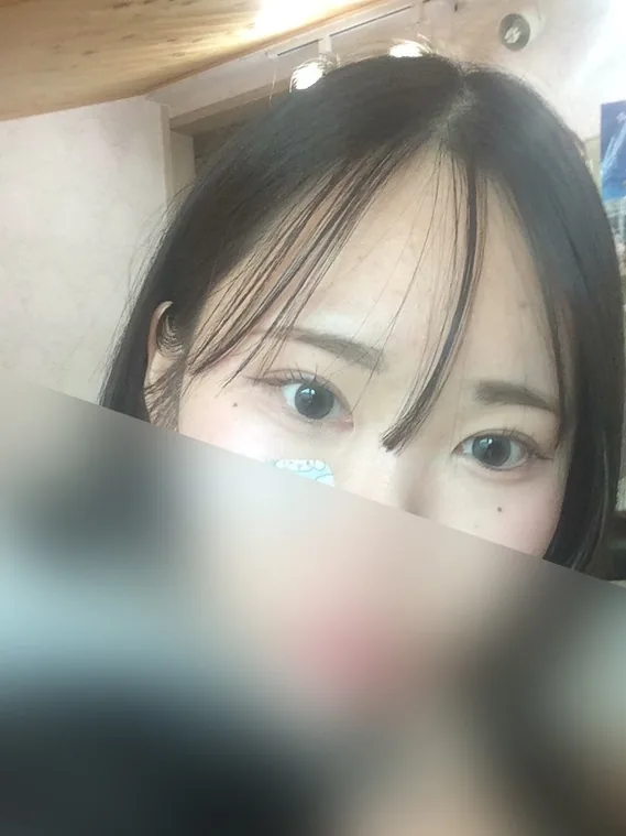 รีวิวหลังผ่าตัดแก้ไขตา