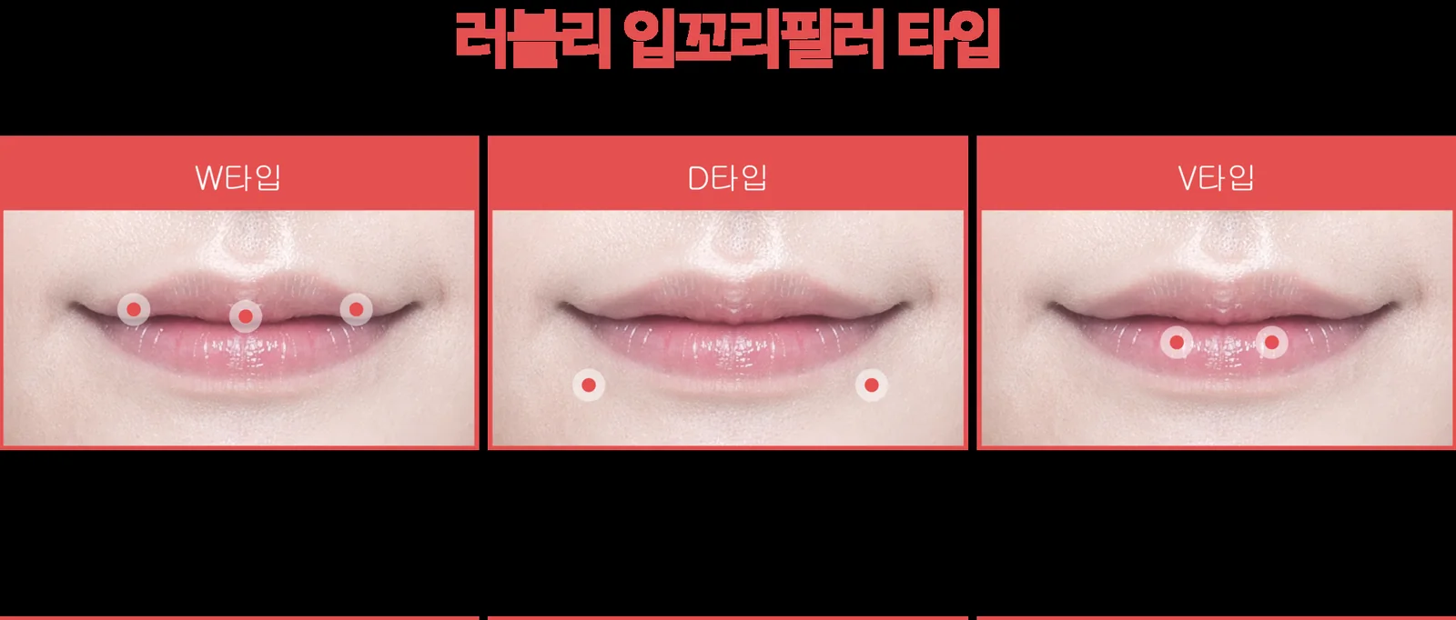 Filler khóe miệng